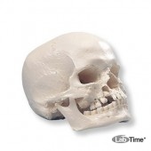 Модель черепа с «волчьей пастью» и с расщелиной в нижней челюсти